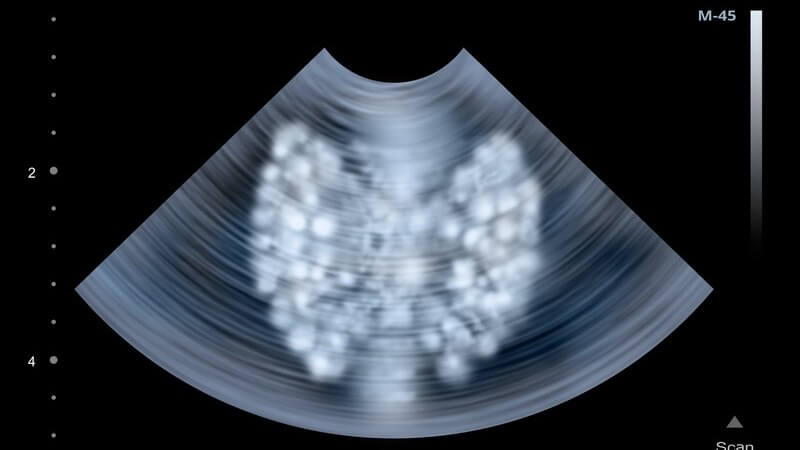 Ultraschallbild der menschlichen Schilddrüse