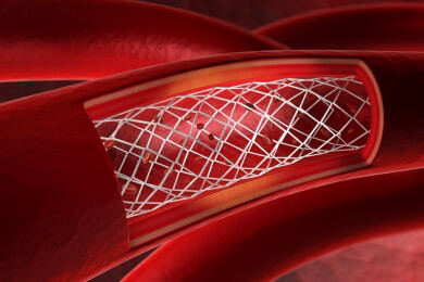 Stent statt Operation bei chronischem Verschluss der Darmarterien