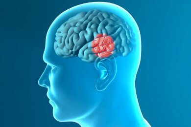 Neuer Therapieansatz bei Parkinson - Forscher finden körpereigenes Antibiotikum im Gehirn