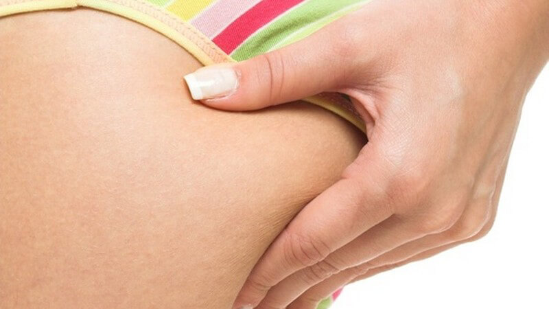 Ausschnitt des Hüft- und Po-Bereichs: Frau mit künstlichen Fingernägeln testet an Po mit gestreifter Unterhose Cellulite