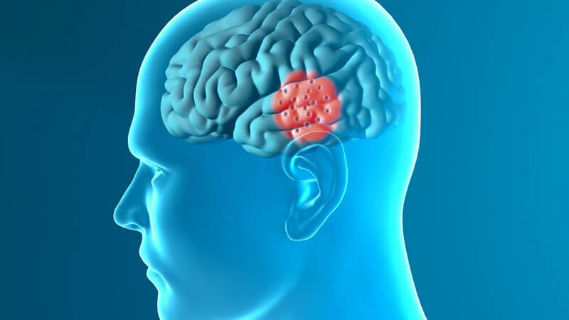 Blaue 3-D-Grafik des Kopfes eines Parkinson-Kranken von der Seite, auf dem Gehirn ist eine Hirnregion rot hervorgehoben
