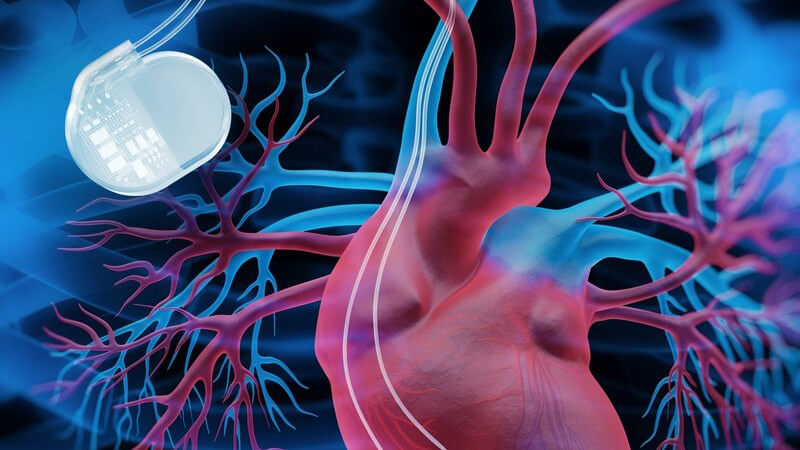 3-D-Grafik eines Herzens mit angeschlossenem Herzschrittmacher