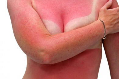 Böses Ende eines schönen Strandtages: Was hilft bei Sonnenbrand?