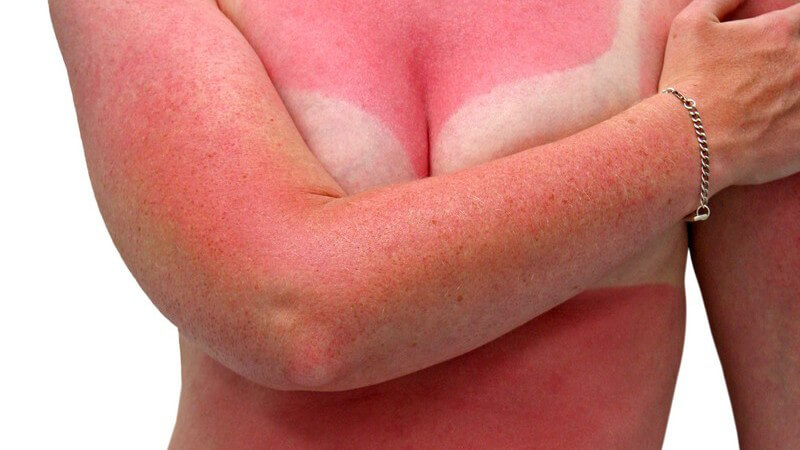 Frauenkörper mit starkem Sonnenbrand