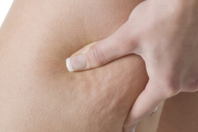 Der böse Bruder der Cellulitis - Ein Lipödem kann zur schmerzhaften Beeinträchtigung werden