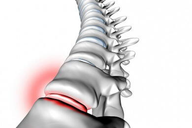 Erstmalig in Deutschland wurde jetzt ein biologisches Bandscheibenimplantat eingesetzt