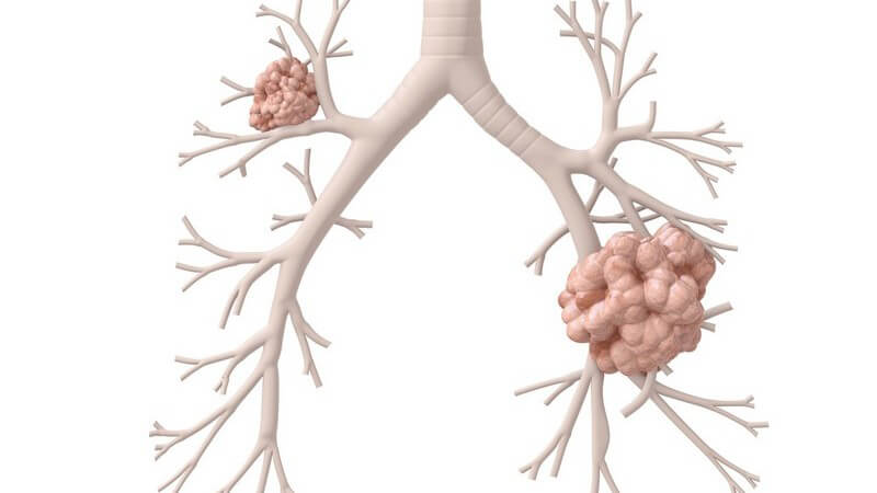 3D Grafik Lungen mit Lungenkrebs