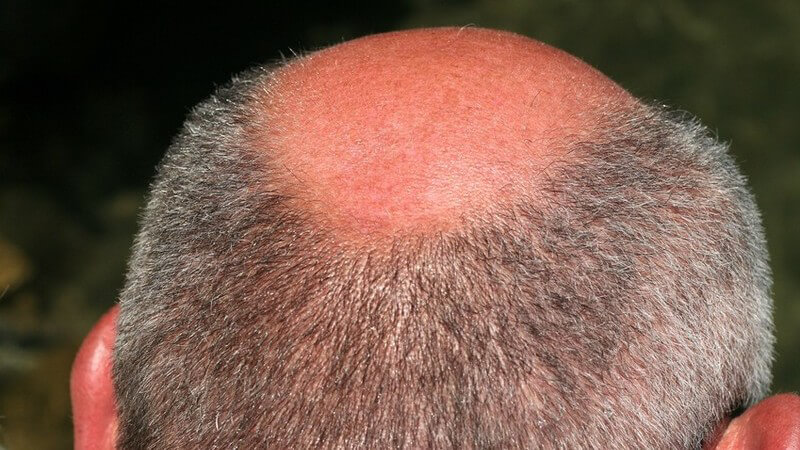 Halber Hinterkopf eines halbergrauten Mannes (graue, melierte Haare) mit Halbglatze