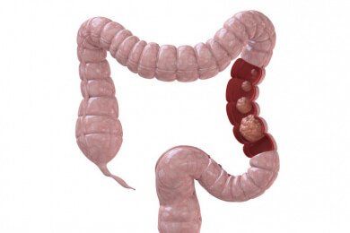 Mit Rotwein gegen Darmkrebs: Wirkstoff Resveratrol hat sich als krebshemmend erwiesen