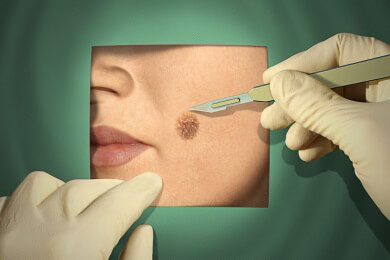 Wie behandelt man Melasmen sinnvoll? Therapie der Hyperpigmentierung ist schwierig