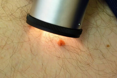 Viele große Melanome werden beim Hautkrebsscreening nicht entdeckt