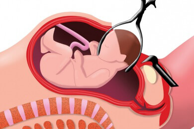 Automechaniker entwickelt Tüte, um Babys aus dem Geburtskanal zu ziehen