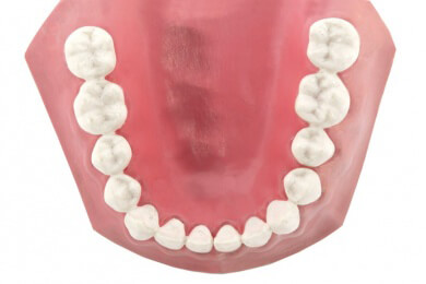 Zahnimplantate: Nicht für jeden sind die Implantate geeignet