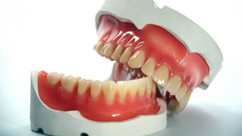 Zähne - Zahnmodell mit schräg auf dem Unterkiefer liegendem Oberkiefer